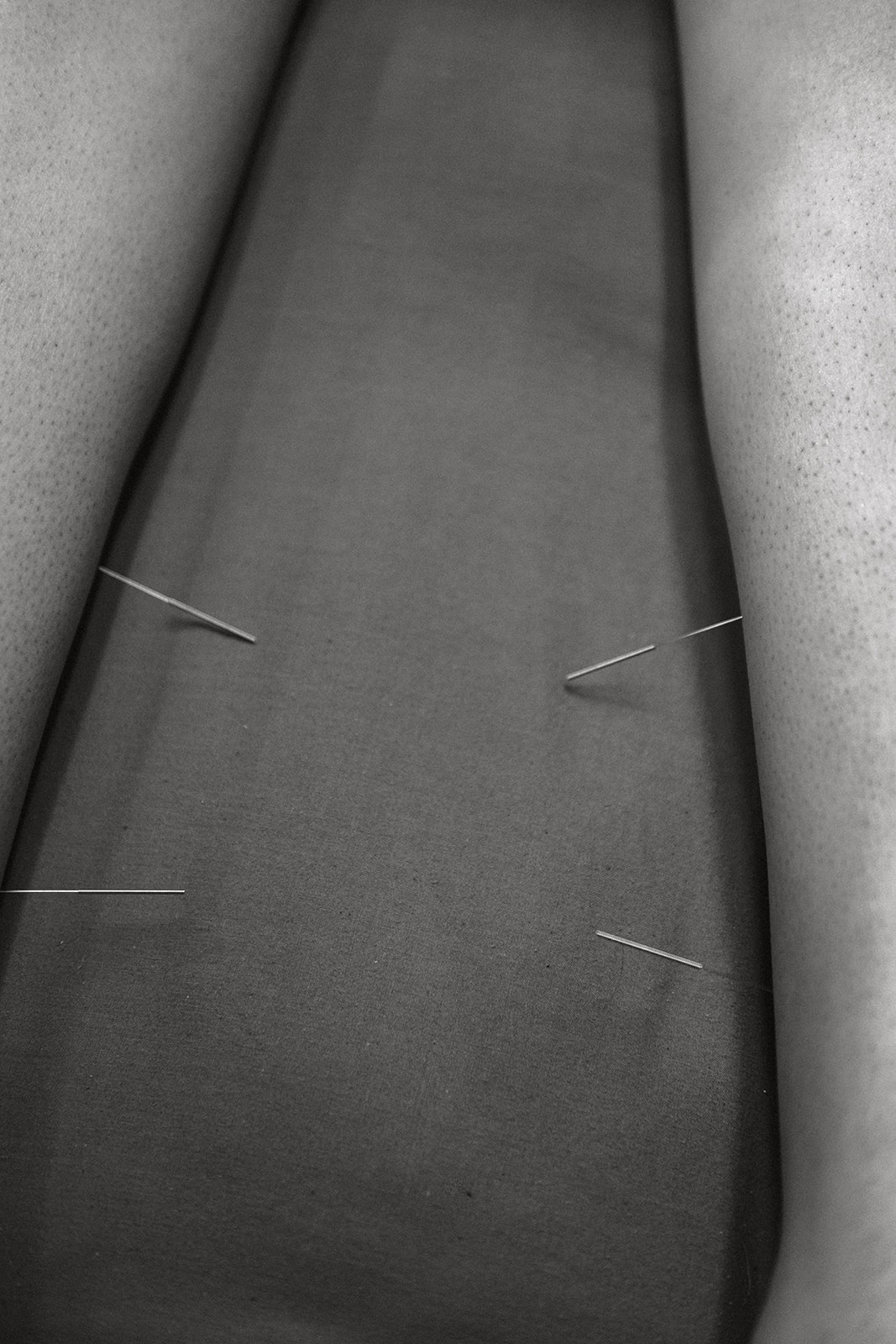 Dry Needling