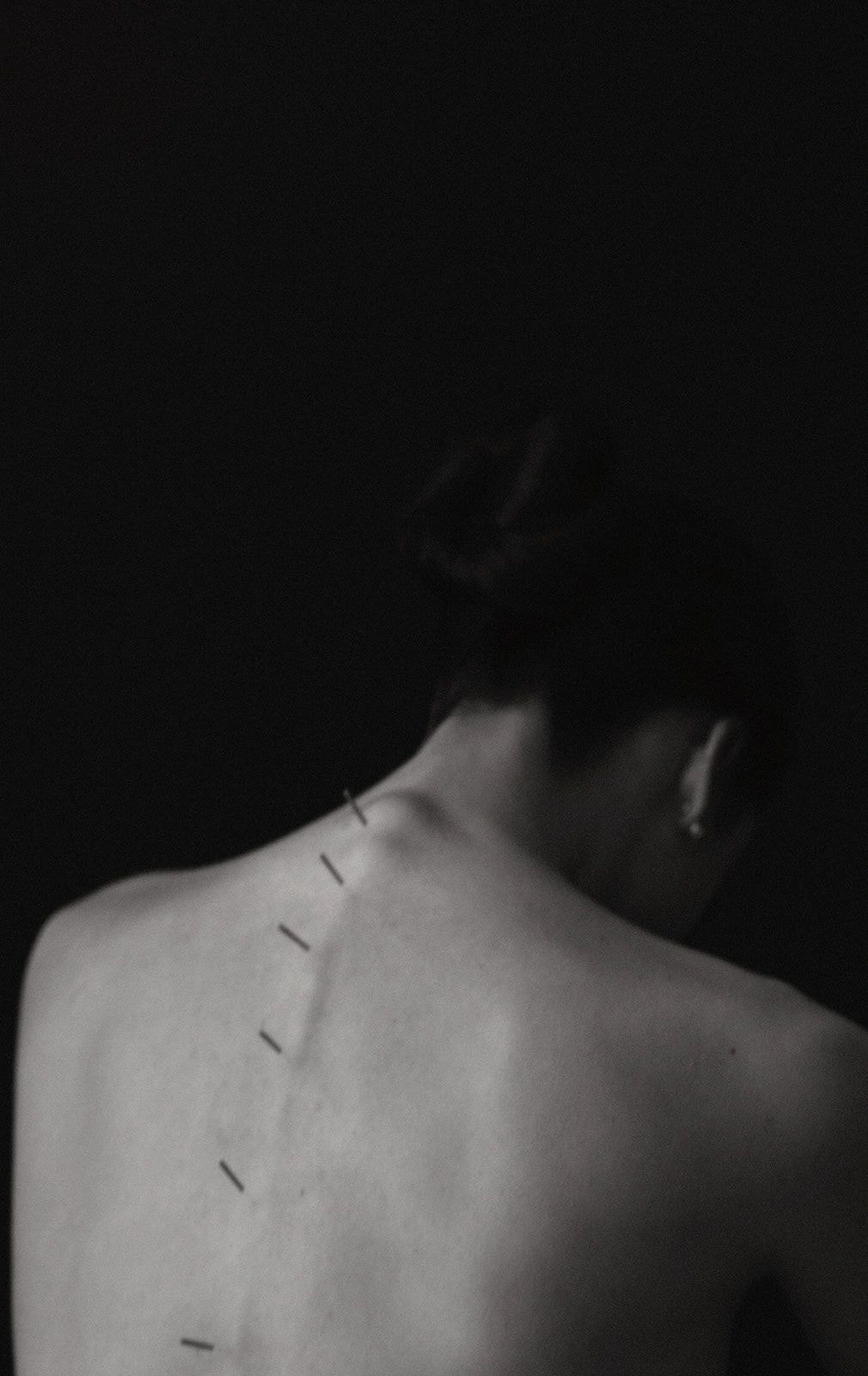 Acupuncture